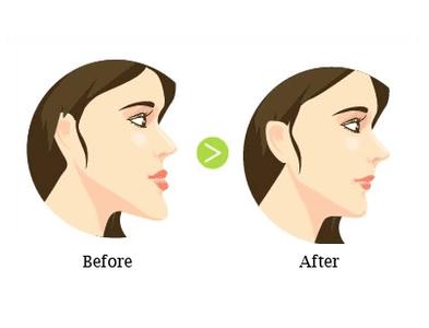 双颌前突的原因都有哪些