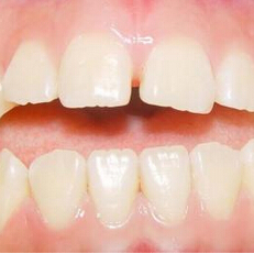 前牙开颌的原因有哪些
