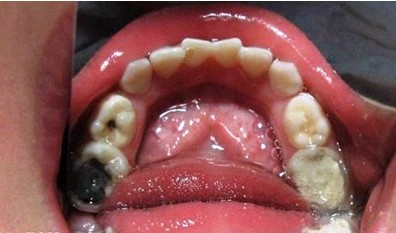牙髓病是怎么引起的