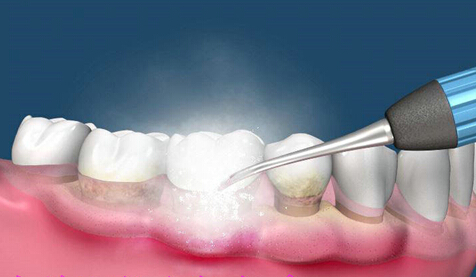 洗牙会造成牙齿松动、损伤吗