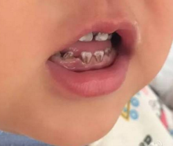 儿童牙齿萌出常见的牙齿发育异常有哪些