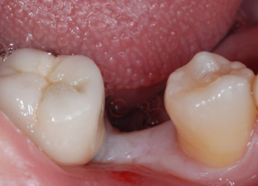 种植牙对人体有害吗
