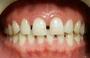 牙齿稀疏有哪些危害