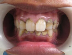 牙齿上的牙结石应该怎么去除