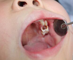 儿童患上蛀牙怎么补牙？