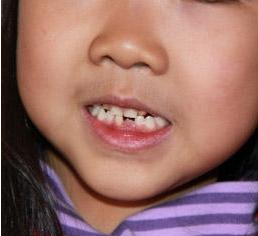 儿童牙齿矫正的安全性