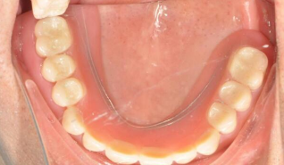 可摘局部义齿修复的分类