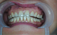 皓齿美白会对牙齿产生副作用吗