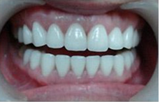 影响全瓷牙寿命的因素主要有什么