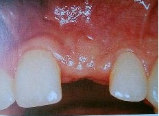 牙龈萎缩能种植牙吗