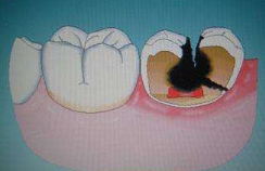 幼儿乳牙龋齿的危害
