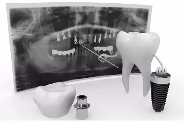 种牙过程是怎样要注意些什么